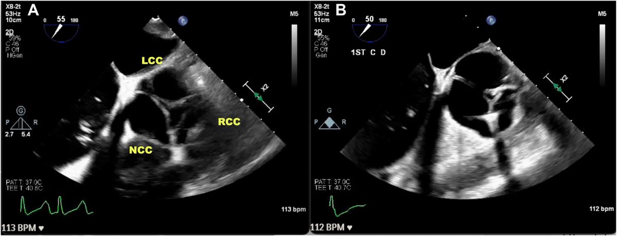 MyJSCAI (@myjscai) on Twitter photo 🆕Case Report: Ever wonder if you could clip the aortic valve? Us too!
Novel Use of #MitraClip for Treatment of Severe #Aortic #Regurgitation - Presented at #SIF2025 đź’ˇ
➡️doi.org/10.1016/j.jsca…
<a href="/jamiemccabeMD/">Jamie McCabe</a> <a href="/drsharpdimitri/">Demetrio Sharp Dimitri, MD, MSc</a> <a href="/DavidElison1/">David Elison</a> <a href="/gb_mackensen/">G. Burkhard Mackensen</a> 🆕Case Report: Ever wonder if you could clip the aortic valve? Us too!
Novel Use of #MitraClip for Treatment of Severe #Aortic #Regurgitation - Presented at #SIF2025 đź’ˇ
➡️doi.org/10.1016/j.jsca…
<a href="/jamiemccabeMD/">Jamie McCabe</a> <a href="/drsharpdimitri/">Demetrio Sharp Dimitri, MD, MSc</a> <a href="/DavidElison1/">David Elison</a> <a href="/gb_mackensen/">G. Burkhard Mackensen</a>