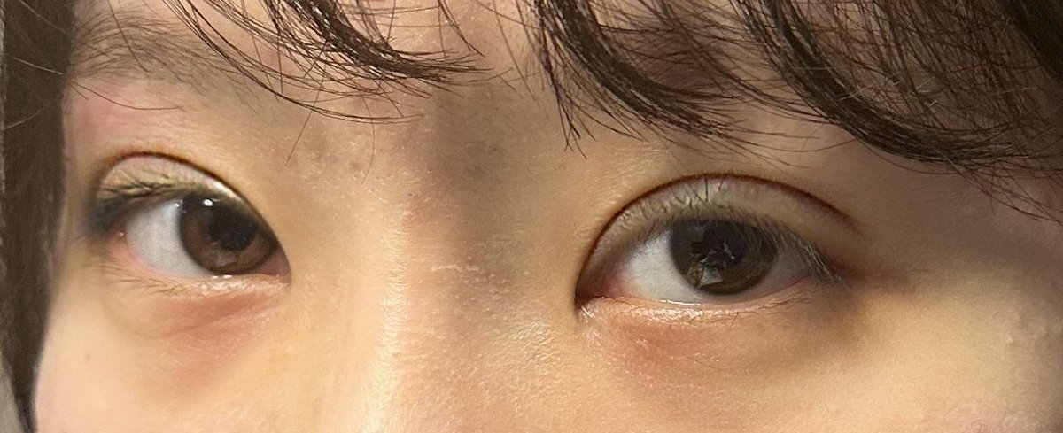 UANDDN's tweet image. #手術日記  #ユニーク整形外科 で
ついにやった #目の再手術 ❣️
痛みもなく、#冷やすケア 頑張り中🧊
皆さん親切で、緊張せずに無事に終わった🤗
 1週間韓国に滞在しながら、しっかり休んで帰ろう！
手術日記を書きながら、変化の過程を記録しようと思う！
早く腫れとアザが引いたら良いなー楽しみ❣️