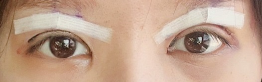 UANDDN's tweet image. #手術日記  #ユニーク整形外科 で
ついにやった #目の再手術 ❣️
痛みもなく、#冷やすケア 頑張り中🧊
皆さん親切で、緊張せずに無事に終わった🤗
 1週間韓国に滞在しながら、しっかり休んで帰ろう！
手術日記を書きながら、変化の過程を記録しようと思う！
早く腫れとアザが引いたら良いなー楽しみ❣️