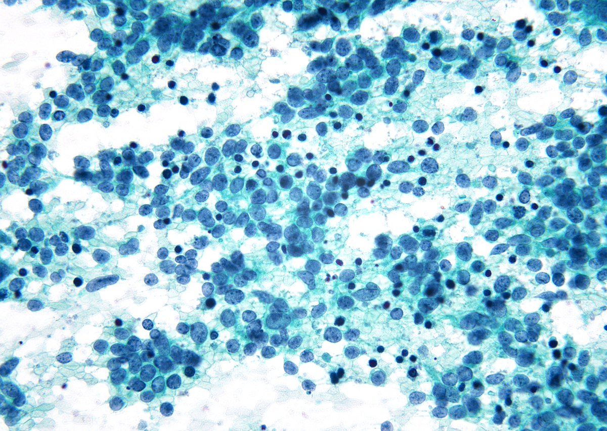 "Apoptotic Bodies" are always helpful in the diagnosis of "Small Cell Carcinoma" over a Carcinoid Tumor. (Mediastinal Node, EBUS-FNA)