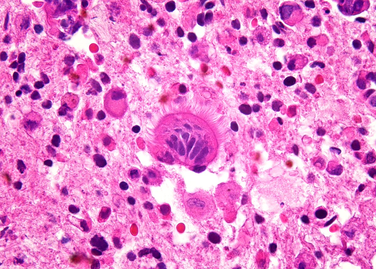 "Innocent Entrapment" - EBUS-FNA of a lung lesion.