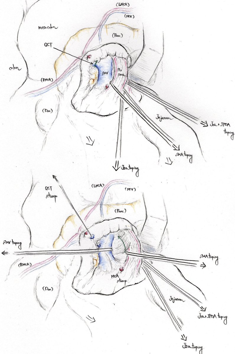 最近描いたオペレコを載せます
mesenteric approach
GCT先に切って、SMV右に、SMA左に引いてダイヤモンド型に展開して、SMAの裏の剥離