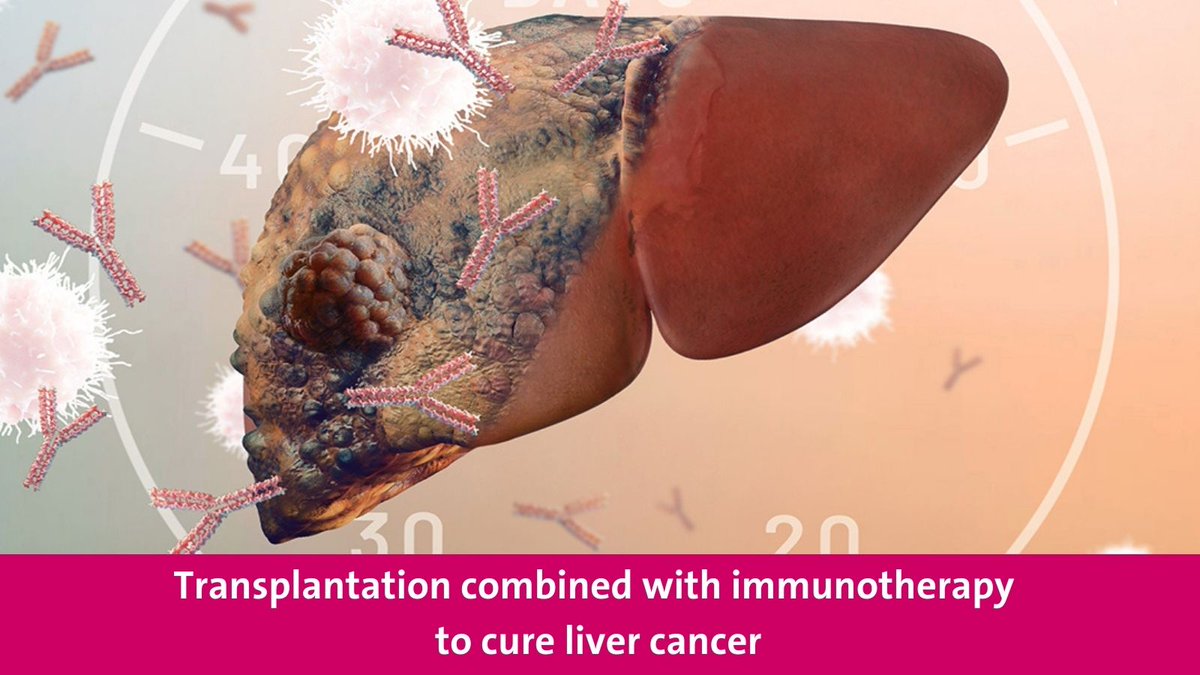 A study led by the UNIGE and the <a href="/hug_ge/">HUG</a> has made a major breakthrough in the treatment of liver cancer. It shows that an interval of 50 days between stopping immunotherapy and liver transplantation significantly reduces the risk of rejection. unige.ch/medias/en/2025…