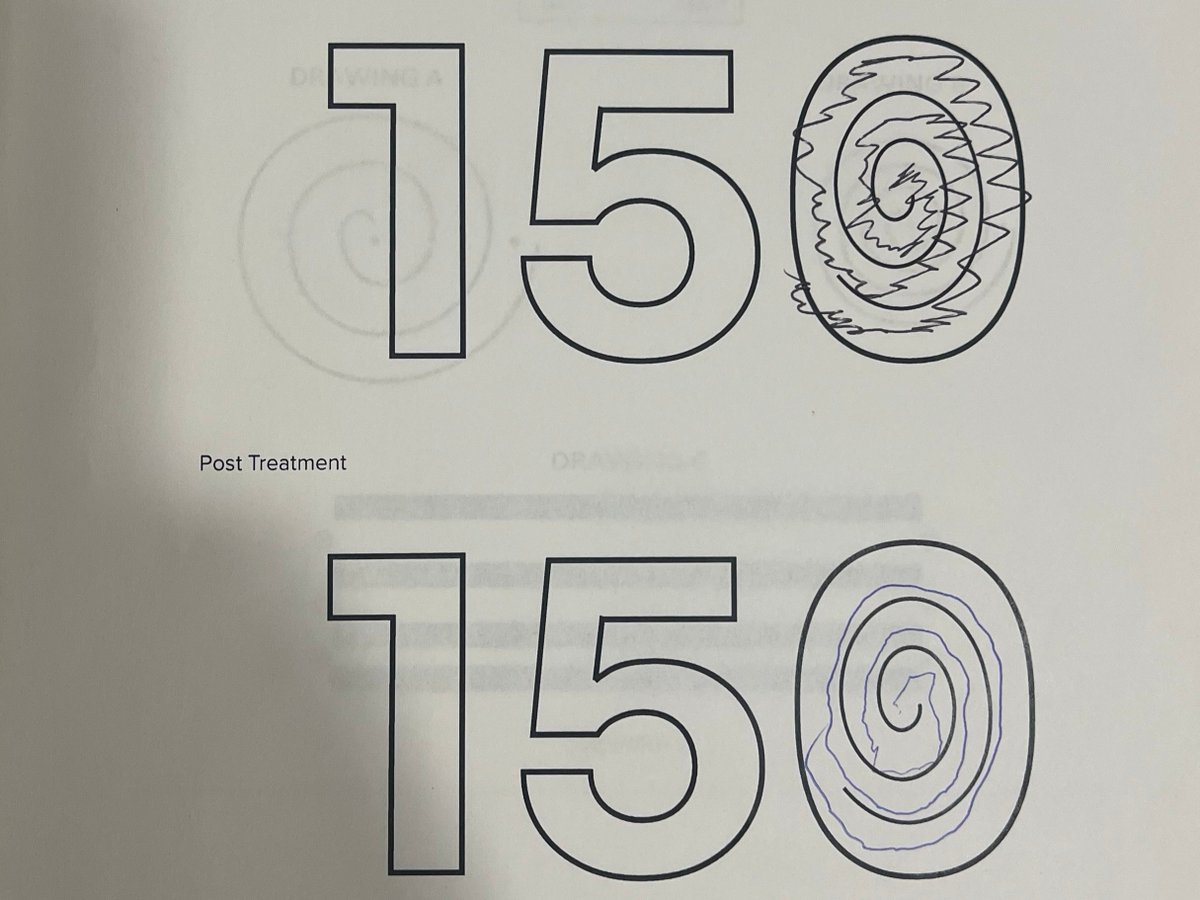 NYU Langone recently celebrated its 150th #FocusedUltrasound treatment! Kudos to Dr. @alonMogilner and Dr. Michael Pourfar, for their collaboration with Bill's second-side treatment for #EssentialTremor.