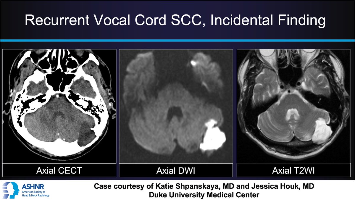 ASHNR (@ashnrsociety) on Twitter photo #ASHNRCOTW #288: Incidental Finding. Thx Dr. <a href="/KatieShp19/">Katie Shpanskaya</a> + @jhoukMD4 case! #ASHNR25
Answer w/ appropriate GIF only -- stay professional & don't spoil it!
<a href="/callyrobs/">Caroline Robson, MBChB</a> <a href="/DShatzkes/">Deborah Shatzkes</a> <a href="/CDP_Rad/">C Douglas Phillips 🇺🇸</a>
<a href="/rhwiggins/">Richard Wiggins</a> <a href="/nakoontz/">Nicholas Koontz</a> <a href="/KRileyMD/">Kalen Riley</a> <a href="/CMGlastonbury/">Christine M Glastonbury, MD</a>
<a href="/tabby_kennedy/">Tabby A. Kennedy, MD</a> @PhilipRChapman <a href="/cmtomblinson/">Courtney Tomblinson, MD</a> #ASHNRCOTW #288: Incidental Finding. Thx Dr. <a href="/KatieShp19/">Katie Shpanskaya</a> + @jhoukMD4 case! #ASHNR25
Answer w/ appropriate GIF only -- stay professional & don't spoil it!
<a href="/callyrobs/">Caroline Robson, MBChB</a> <a href="/DShatzkes/">Deborah Shatzkes</a> <a href="/CDP_Rad/">C Douglas Phillips 🇺🇸</a>
<a href="/rhwiggins/">Richard Wiggins</a> <a href="/nakoontz/">Nicholas Koontz</a> <a href="/KRileyMD/">Kalen Riley</a> <a href="/CMGlastonbury/">Christine M Glastonbury, MD</a>
<a href="/tabby_kennedy/">Tabby A. Kennedy, MD</a> @PhilipRChapman <a href="/cmtomblinson/">Courtney Tomblinson, MD</a>