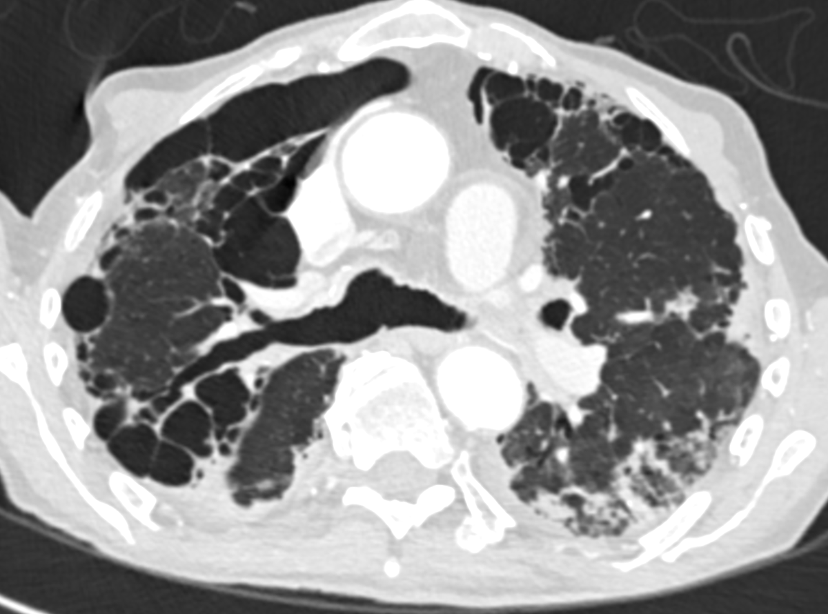 Pneumothorax dissecting the pulmonary ligament and intersegmental septum in a patient with PPFE (compare with previous CT)

Always keeping this two articles close by to explain to residents 
ajronline.org/doi/10.2214/aj…
academic.oup.com/bjrcr/article/…

<a href="/LaurenGroner/">Lauren Kriger Groner</a> <a href="/howardm19/">Howard Mann</a> <a href="/hochhegger/">Bruno Hochhegger</a>