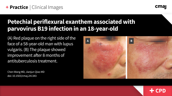 Lupus vulgaris is a common cutaneous manifestation of Mycobacterium tuberculosis and is a slow-growing, superficial lesion typically located on the head or neck.
➡️ cmaj.ca/lookup/doi/10.…
(earn CPD credits)