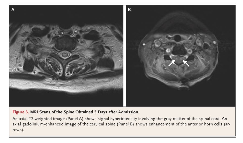 Takahiro Matsuo (Taka), MD (@takamatsuo_id) on Twitter photo 【Unveiling the Unforeseen】<a href="/NEJM/">NEJM</a> Mar 5 2025
Important case!
Congrats Ale, Mac, and Dr. Razonable🎉
<a href="/MariAleMendozaD/">Maria Alejandra Mendoza, MD</a> <a href="/S_Chesdachai/">S. Mac Chesdachai</a> <a href="/RazonableMD/">Raymund Razonable</a> <a href="/MayoClinicINFD/">Mayo Clinic Infectious Diseases</a>
nejm.org/doi/full/10.10… 【Unveiling the Unforeseen】<a href="/NEJM/">NEJM</a> Mar 5 2025
Important case!
Congrats Ale, Mac, and Dr. Razonable🎉
<a href="/MariAleMendozaD/">Maria Alejandra Mendoza, MD</a> <a href="/S_Chesdachai/">S. Mac Chesdachai</a> <a href="/RazonableMD/">Raymund Razonable</a> <a href="/MayoClinicINFD/">Mayo Clinic Infectious Diseases</a>
nejm.org/doi/full/10.10…
