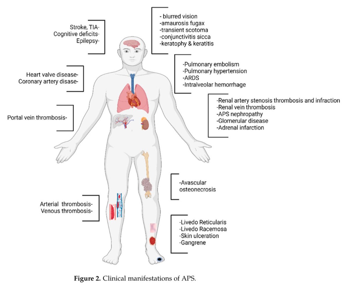 hardik4u24's tweet image. Antiphospholipid Syndrome (APS): The Silent Thrombophilia

From molecular pathogenesis to devastating thrombotic complications—#APS is a ticking time bomb! ⏳🧬

📖 APS review: doi.org/10.3390/jcm140… (2025) 

#Nephrology #Thrombosis #Lupus #MedTwitter  #Rheumatology #Autoimmune