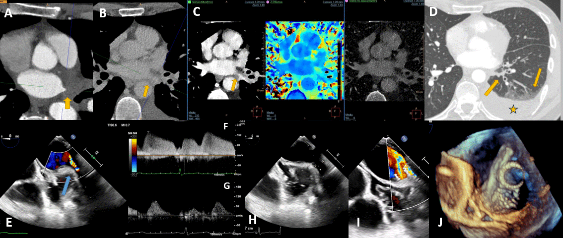 InvasiveCardiol's tweet photo. 🔖 The March issue is available now! 
 https://t.co/OCUJa78oLG
@bahadirsimsekmd @esbrilakis @roytaoutel @icarrionsanchez @Dr_JHAnderson @DLBHATTMD #cardioTwitter #cardioX #cardiology #interventionalcardiology #TAVR #congenitalheartdisease #HeartHealth #CardioCare https://t.co/4PEvQXCdvb