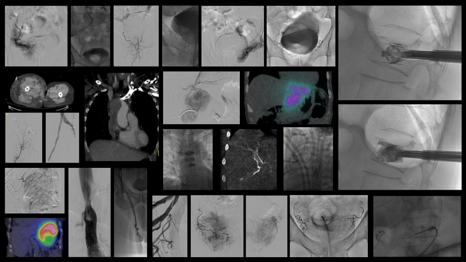 Kara Fitzgerald, MD (@kmfitzmd) on Twitter photo A diverse 6th block at UW Montlake with PAE, interventional oncology, inferior venacavography, vertebral augmentation, TCVO and iliocaval recanalization and reconstruction. #IRAD #IRadRes <a href="/UofWa_IR/">University of Washington IR Residency</a> A diverse 6th block at UW Montlake with PAE, interventional oncology, inferior venacavography, vertebral augmentation, TCVO and iliocaval recanalization and reconstruction. #IRAD #IRadRes <a href="/UofWa_IR/">University of Washington IR Residency</a>