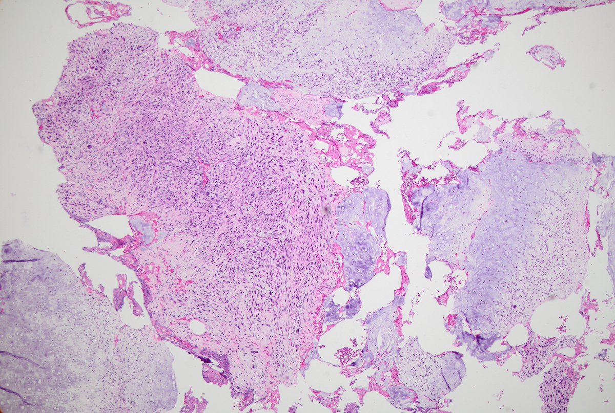 JDCo2pock's tweet photo. Dedifferentiated chondrosarcoma of the palate/orbit https://t.co/t64SqGRMg8