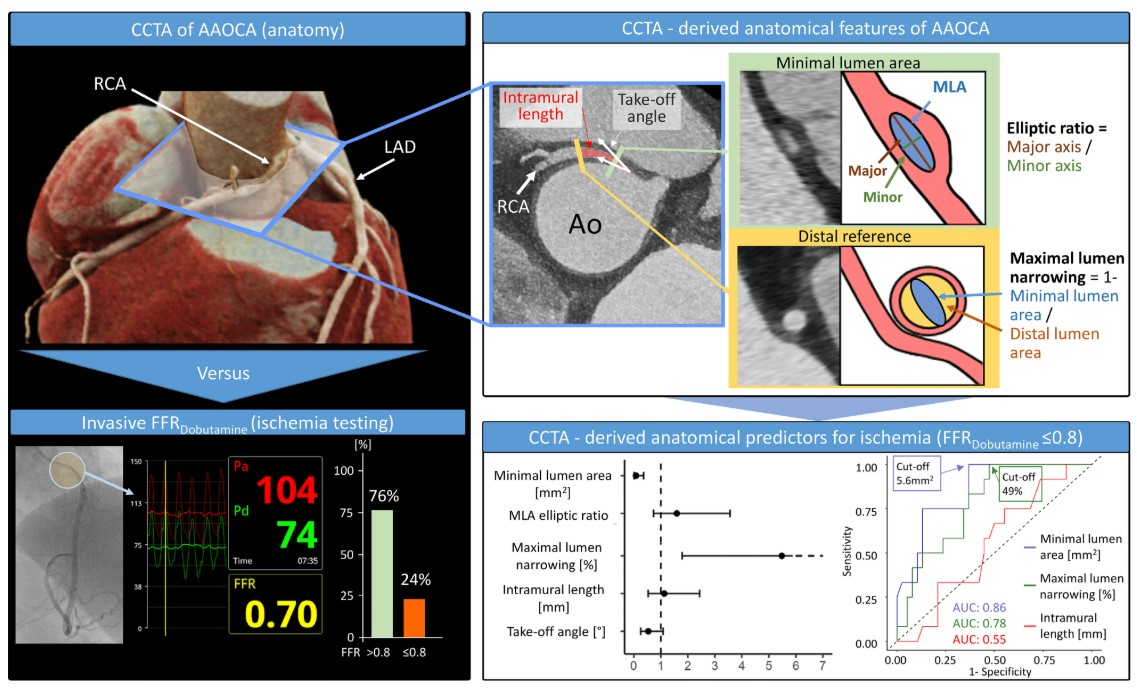 Circulation (@circaha) on Twitter photo Among patients with an anomalous aortic origin of the right coronary artery, coronary artery CT can be used to safely risk stratify individuals <a href="/chrisgraeni/">Christoph Gräni</a> <a href="/inselgruppe/">Insel Gruppe</a> <a href="/BernCVRC/">Cardiovascular Research Cluster (CVRC)</a> <a href="/13Kakiz/">R.Kakizaki</a> <a href="/yasushiueki/">植木康志</a> <a href="/biglermarius/">Marius Reto Bigler</a> @Fbiccire <a href="/isaacshiri/">Isaac Shiri Lord</a> <a href="/chrisgraeni/">Christoph Gräni</a> ahajournals.org/doi/full/10.11… Among patients with an anomalous aortic origin of the right coronary artery, coronary artery CT can be used to safely risk stratify individuals <a href="/chrisgraeni/">Christoph Gräni</a> <a href="/inselgruppe/">Insel Gruppe</a> <a href="/BernCVRC/">Cardiovascular Research Cluster (CVRC)</a> <a href="/13Kakiz/">R.Kakizaki</a> <a href="/yasushiueki/">植木康志</a> <a href="/biglermarius/">Marius Reto Bigler</a> @Fbiccire <a href="/isaacshiri/">Isaac Shiri Lord</a> <a href="/chrisgraeni/">Christoph Gräni</a> ahajournals.org/doi/full/10.11…