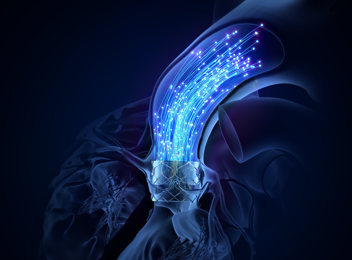 AnterisTech's tweet image. In this fireside chat at the TD Cowen Healthcare Conference, Anteris CEO Wayne Paterson discusses the history of the company and how we sought to address unmet needs in aortic stenosis patients. Anteris created a first-in-class biomimetic TAVR valve by asking different questions…