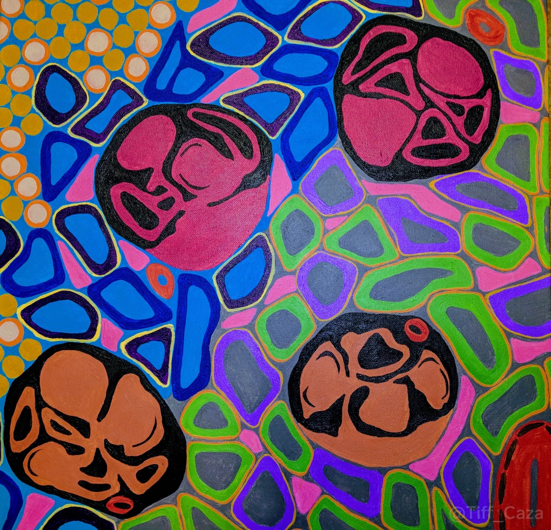 This painting shows glomeruli with nodular mesangial expansion and arterial hyalinosis, changes frequently seen in diabetic nephropathy. Diabetic nephropathy affects 30-40% of patients with diabetes mellitus, and is a major cause of end stage kidney disease in these patients.