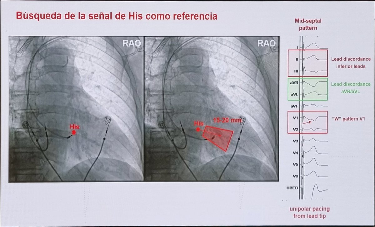 Joaquín Vila (@joaquin_vilag) on Twitter photo Refrescando conceptos sobre estimulación fisiológica y marcapasos sin cables en la #casadelcorazon 🫀
<a href="/secardiologia/">Soc Esp Cardiología</a> <a href="/JovenesSec/">JóvenesSEC</a> <a href="/luciacaanales/">Lucía</a> <a href="/Azlaragarcia/">Alejandro Lara García</a> Refrescando conceptos sobre estimulación fisiológica y marcapasos sin cables en la #casadelcorazon 🫀
<a href="/secardiologia/">Soc Esp Cardiología</a> <a href="/JovenesSec/">JóvenesSEC</a> <a href="/luciacaanales/">Lucía</a> <a href="/Azlaragarcia/">Alejandro Lara García</a>