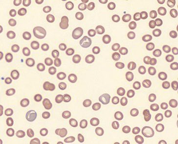 J Mark Sloan (@jmarksloan) on Twitter photo A proud moment:
Showing our adult βo/βo thalassemia patient her first reticulocytes after her Casgevy infusion.
The first commercial gene therapy infusion in New England.
A <a href="/The_BMC/">Boston Medical Center</a> team effort. A proud moment:
Showing our adult βo/βo thalassemia patient her first reticulocytes after her Casgevy infusion.
The first commercial gene therapy infusion in New England.
A <a href="/The_BMC/">Boston Medical Center</a> team effort.