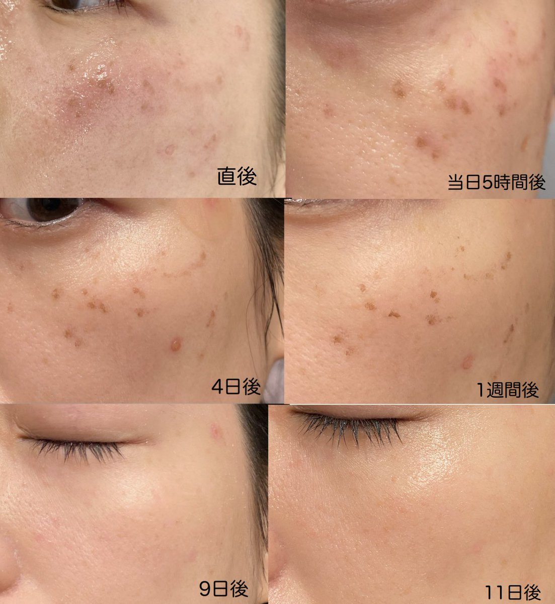 久しぶりの投稿だ...！去年は妊娠出産で秒で過ぎました.🥲コスメは変わらず買ってるのでまたマイペースにやります👶🏻
産後超増えたシミを先日お掃除してきました〜。beforeはこんなにひどい！！ピコスポット打ち放題で施術後11日後これだけ綺麗になった！
取りきれなかった所はIPLでやっつけます☺️