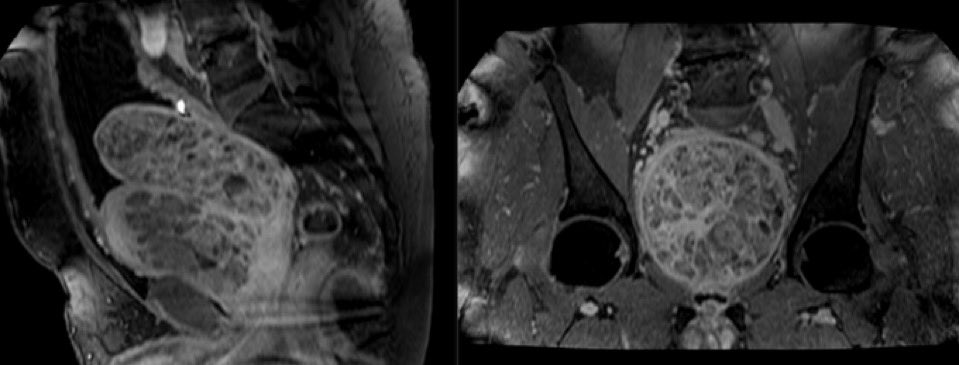 Rushil Rawal (@rushilyrawal) on Twitter photo Check out our publication on a patient with a 1000g prostate and how it was managed with a robotic-assisted simple prostatectomy. The Kilogland! doi.org/10.1016/j.eucr…
<a href="/MichaelAhdootMD/">Michael Ahdoot MD</a> <a href="/joshuadavood/">Joshua Davood</a> @UroResidentsCS Check out our publication on a patient with a 1000g prostate and how it was managed with a robotic-assisted simple prostatectomy. The Kilogland! doi.org/10.1016/j.eucr…
<a href="/MichaelAhdootMD/">Michael Ahdoot MD</a> <a href="/joshuadavood/">Joshua Davood</a> @UroResidentsCS
