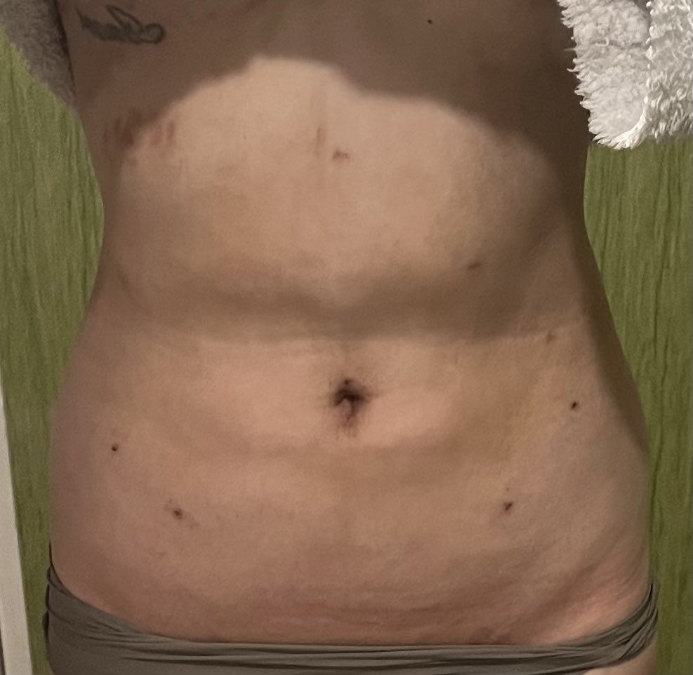 dt2週間目
☑️抜糸終わって３日目
☑️太腿のあざ無くなった
☑️まだ筋肉痛のような痛み
☑️痛み止めは無しで大丈夫👌
☑️やっと細くなってきた
☑️寝起きは段差マシ
まだまだ細くなるはず✨✨
楽しみでしかない🤭
#エッジラインクリニック
#脂肪吸引
#整形
#韓国