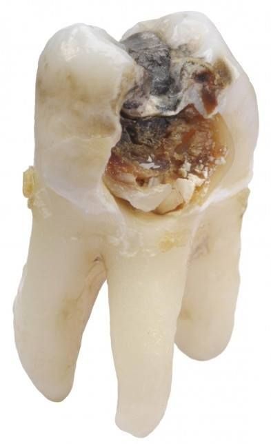 odontomap's tweet photo. 🧿 De 3 a 5 años toma la destrucción del diente por caries. Significa que la higiene es deficiente y no ha visitado al DENTISTA durante ese tiempo. No dejes que tú ÓRGANO DENTAL se destruya. Visita a tu DENTISTA cada 3 meses.

#CariesDental #PérdidaDental #SaludBucal #Odontomap https://t.co/1PthFR1KUk