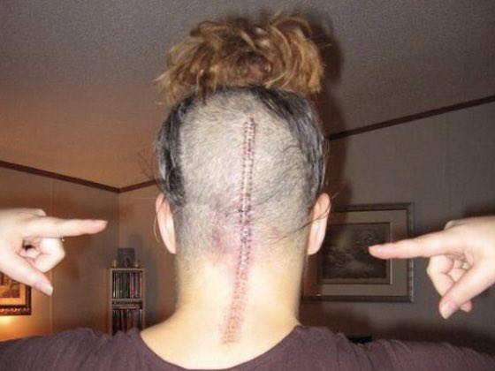 Queen3614's tweet photo. @DevanSinha @Neuromed_ It’s my personal image, my actual brain.  I have chiari. The MRI I posted, of course it’s not the same as the first one, I didn’t post that one. Here is after day 8, is that better for you? https://t.co/ivZYLf7jBB