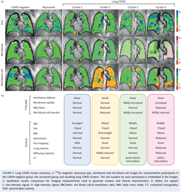 Don Sin (@donsin4) on Twitter photo <a href="/doclip1/">brian lipworth</a> <a href="/EricTopol/">Eric Topol</a> <a href="/ScienceMagazine/">Science Magazine</a> <a href="/ERSpublications/">ERS publications</a> Interestingly, we could see this (small airway/gas exchange problems) using #xenon #MRI bit.ly/42uia1J <a href="/doclip1/">brian lipworth</a> <a href="/EricTopol/">Eric Topol</a> <a href="/ScienceMagazine/">Science Magazine</a> <a href="/ERSpublications/">ERS publications</a> Interestingly, we could see this (small airway/gas exchange problems) using #xenon #MRI bit.ly/42uia1J