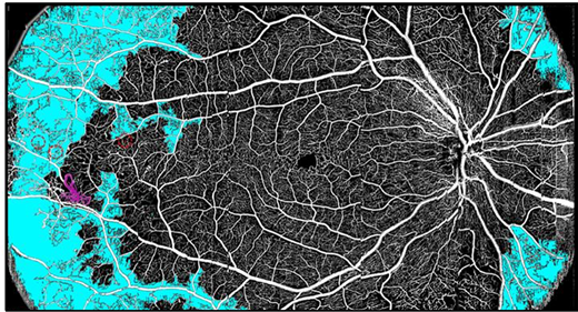 New Review article in the OCT issue bit.ly/3u6vw7v by Tristan T. Hormel, David Huang &amp; Yali Jia <a href="/YaliJiaOCT/">Yali Jia</a> <a href="/CaseyEye/">OHSU Casey Eye</a> discusses advances in OCT angiography. 
doi.org/10.1167/tvst.1…