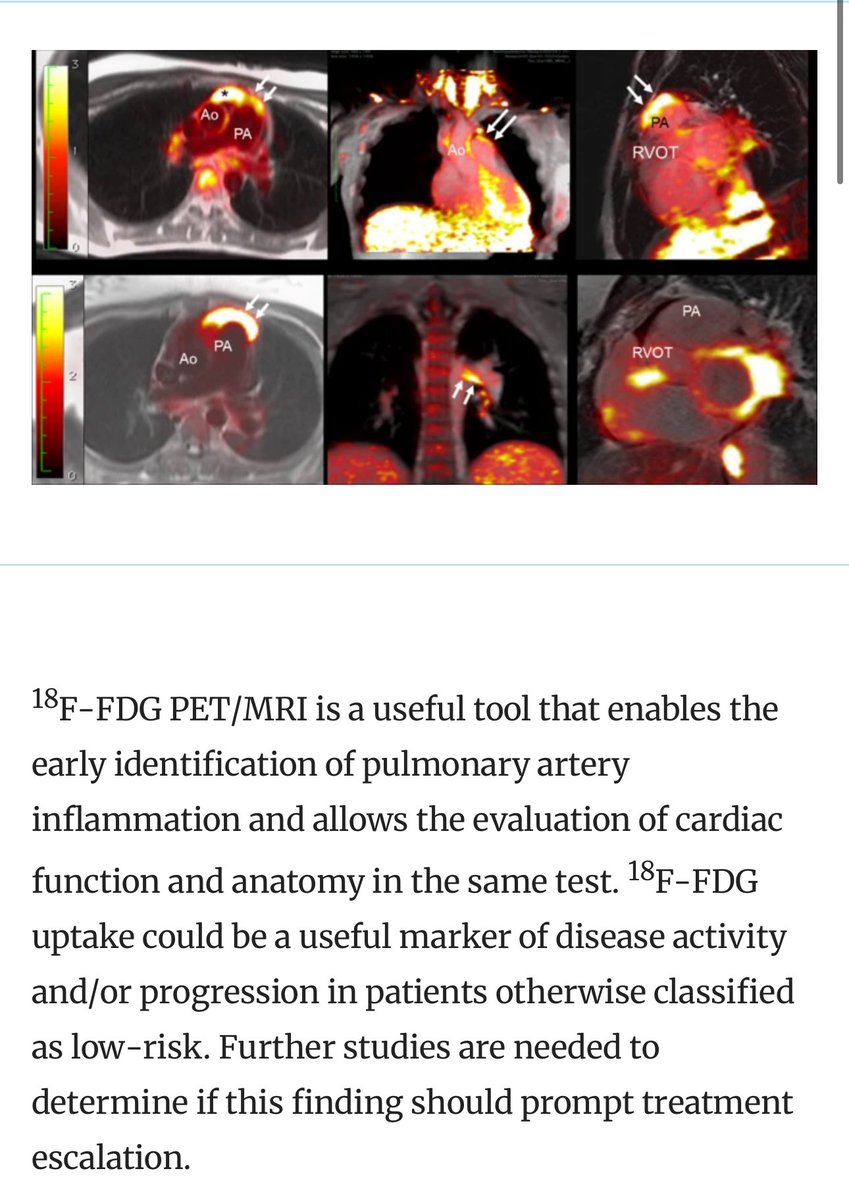Busra Cangut, MD, MS (@busracangutmd) on Twitter photo Check out our latest publication, highlighted as the Image of the Month.
<a href="/anadevesa5/">Ana Devesa</a> <a href="/mgtrivieri/">Maria G. Trivieri</a> <a href="/zahifayad/">zahifayad</a> <a href="/BMEIIsinai/">BioMedical Engineering and Imaging Institute</a> <a href="/MountSinaiHeart/">Mount Sinai Fuster Heart Hospital</a> <a href="/MountSinaiDMIR/">Mount Sinai Diag, Molecular, and Interv Radiology</a>
➡️ link.springer.com/article/10.100… Check out our latest publication, highlighted as the Image of the Month.
<a href="/anadevesa5/">Ana Devesa</a> <a href="/mgtrivieri/">Maria G. Trivieri</a> <a href="/zahifayad/">zahifayad</a> <a href="/BMEIIsinai/">BioMedical Engineering and Imaging Institute</a> <a href="/MountSinaiHeart/">Mount Sinai Fuster Heart Hospital</a> <a href="/MountSinaiDMIR/">Mount Sinai Diag, Molecular, and Interv Radiology</a>
➡️ link.springer.com/article/10.100…