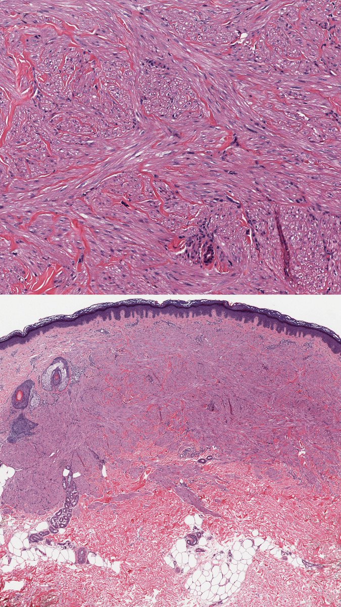Charles Herndon (@drcyclopath) on Twitter photo #1 of 3 spindle cell lesions: cutaneous _____
A) neurofibroma
B) schwannoma
C) leiomyoma
D) something else
π¬dpa-dapa.com/public/displayβ¦
#BSTPath #PathTwitter #Pathology #DermPath #1 of 3 spindle cell lesions: cutaneous _____
A) neurofibroma
B) schwannoma
C) leiomyoma
D) something else
π¬dpa-dapa.com/public/displayβ¦
#BSTPath #PathTwitter #Pathology #DermPath