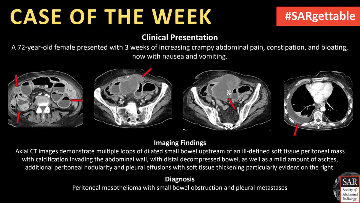 Society of Abdominal Radiology | SAR (@societyabdrad) on Twitter photo The answer to last week's #SARgettable Case of the Week, contributed by <a href="/ErinCookeMD/">Erin Cooke, MD</a>, is: Peritoneal mesothelioma with small bowel obstruction and pleural metastases. Thanks for playing! The answer to last week's #SARgettable Case of the Week, contributed by <a href="/ErinCookeMD/">Erin Cooke, MD</a>, is: Peritoneal mesothelioma with small bowel obstruction and pleural metastases. Thanks for playing!