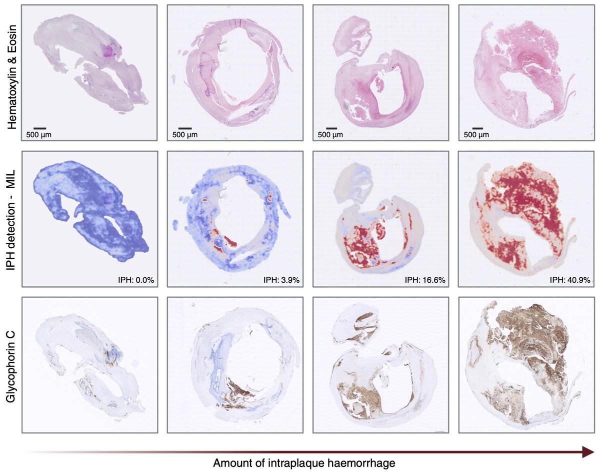 Athero-Express (@atheroexpress) on Twitter photo 2/ With data from the <a href="/atheroexpress/">Athero-Express</a>, we developed a framework to analyse whole-slide images🔬 for better IPH detection and analysis. 📊 H&E staining showed strong results, and combining it with other stains further improved accuracy. 2/ With data from the <a href="/atheroexpress/">Athero-Express</a>, we developed a framework to analyse whole-slide images🔬 for better IPH detection and analysis. 📊 H&E staining showed strong results, and combining it with other stains further improved accuracy.