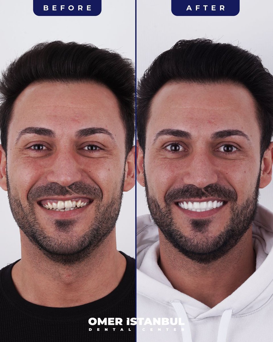 OmerIstanbultr's tweet image. Shker's trusted Omer Istanbul to fix his dental issues, and the result left him impressed. A fresh smile that says it all!😁👌

Free Consultation ⬇️ ☎️
+90 552 840 34 34
.
.
.
#DentalSolution #DentalImplants #ZirconiumCrowns #HollywoodSmile #IstanbulDentist #OralHealth
