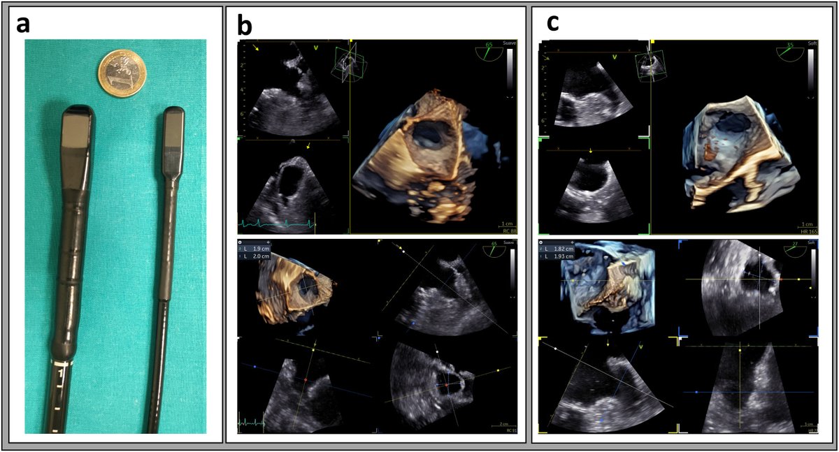 REC Publications (@revespcardiol) on Twitter photo Abordaje minimalista para el cierre percutáneo de la orejuela izquierda mediante minisonda transesofágica 4D #REC
<a href="/lsanchisruiz/">Laura Sanchis</a> <a href="/pedro_cepas/">Pedro Cepas</a> <a href="/ejfu0209/">Eduardo Flores-Umanzor</a> <a href="/AnderRegueiro/">Ander Regueiro</a> <a href="/masitges/">marta sitges</a> <a href="/freixa_xavier/">Xavier Freixa</a>
revespcardiol.org/es-abordaje-mi… Abordaje minimalista para el cierre percutáneo de la orejuela izquierda mediante minisonda transesofágica 4D #REC
<a href="/lsanchisruiz/">Laura Sanchis</a> <a href="/pedro_cepas/">Pedro Cepas</a> <a href="/ejfu0209/">Eduardo Flores-Umanzor</a> <a href="/AnderRegueiro/">Ander Regueiro</a> <a href="/masitges/">marta sitges</a> <a href="/freixa_xavier/">Xavier Freixa</a>
revespcardiol.org/es-abordaje-mi…