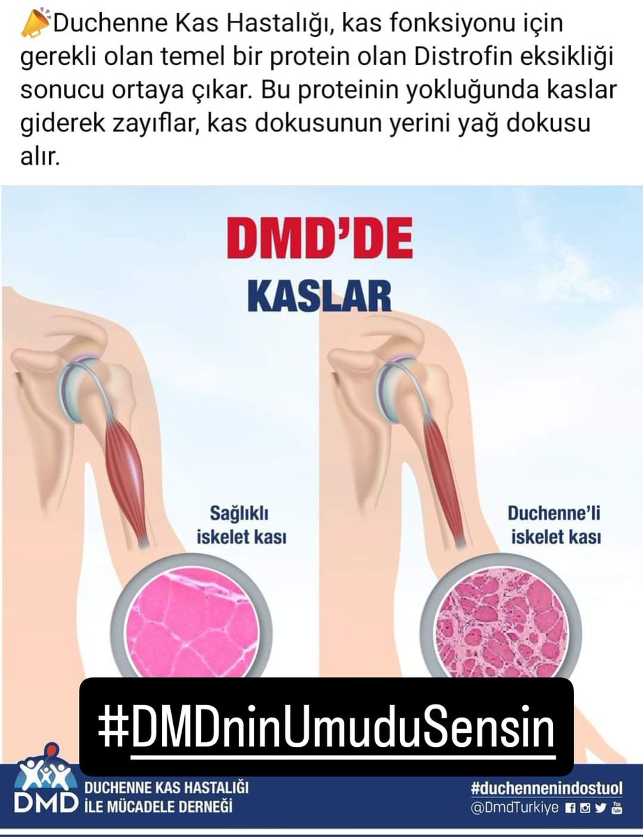 <a href="/DMDTurkiye/">DMD Türkiye</a> Haydi durma bir el at çünkü #DmdninUmuduSensin