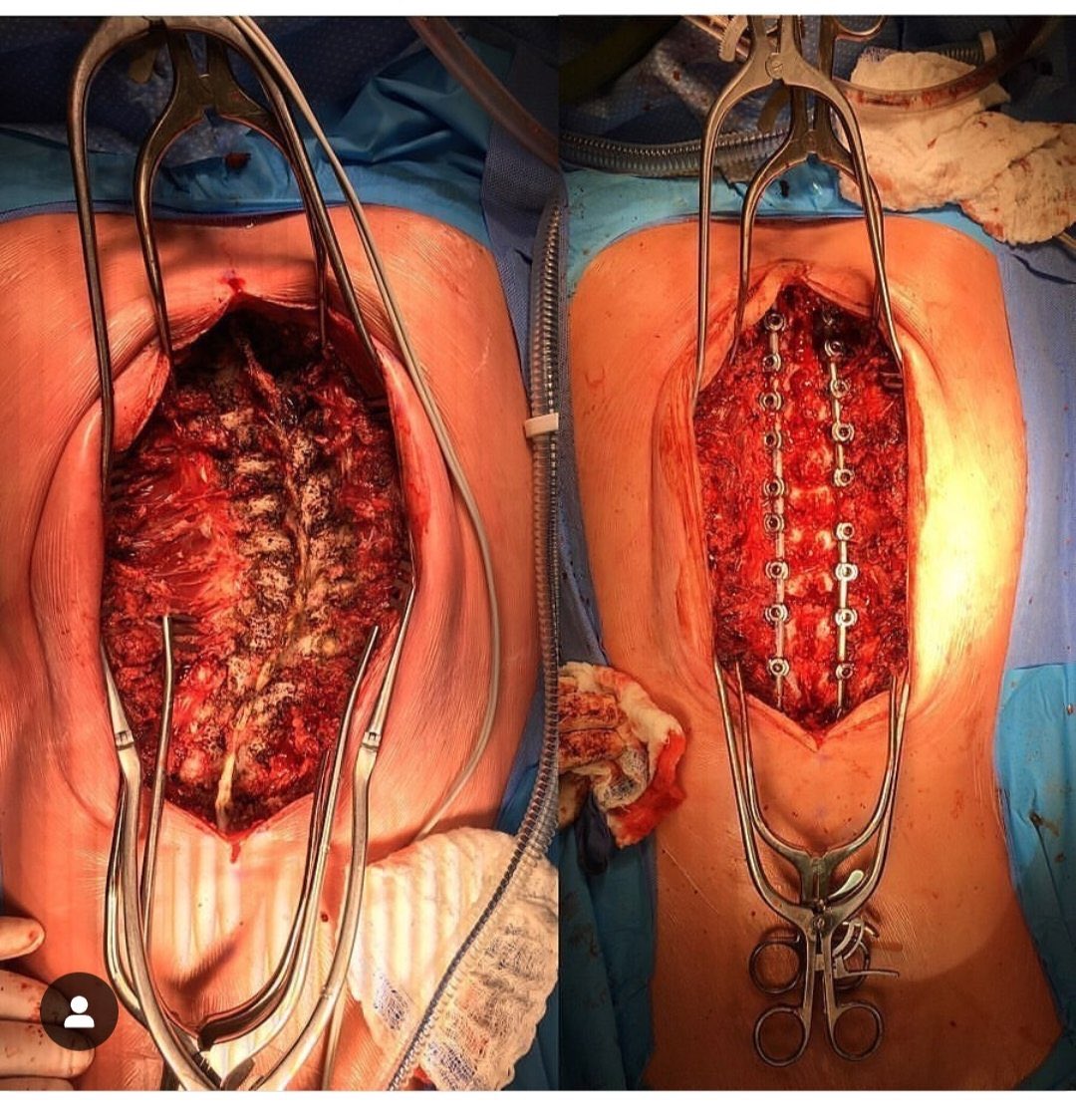 HealthSimplex's tweet image. Medicine is just pure MAGIC!!!

These are the operative photos of a 5 hour scoliosis correction/alignment surgery done in an 18-year-old female that was found to have idiopathic scoliosis when was 14.