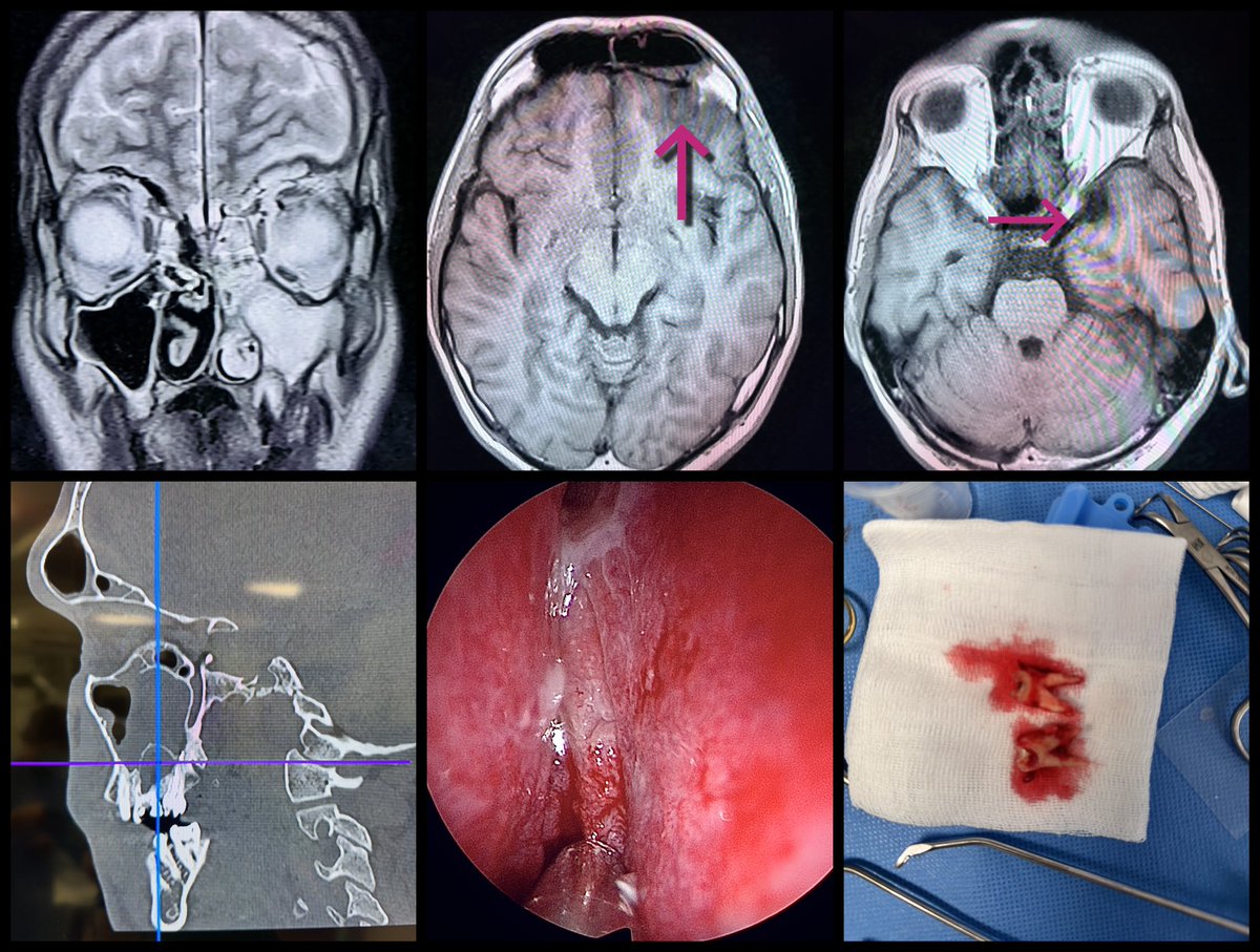 MartaKwiat_ska's tweet photo. another missed #ODS case
23 yo pt with meningitis and focal deficits admitted today
Previous #ENT consult inconclusive, but on CT massive #periapical lesion and sinusitis…intra op pus everywhere in tooth socket #extraction aswell
@JohnCraigNose @ent_ams
Check the 🦷!! https://t.co/nAhstcSR3c