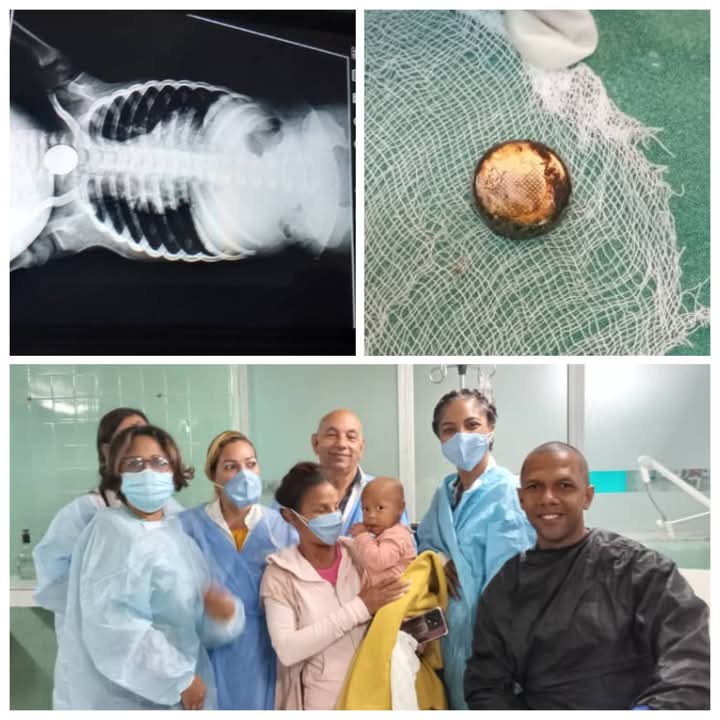 👧Una niña de un año de edad sometida a cirugía este jueves en el hospital pediátrico de Santiago de Cuba para extraerle un cuerpo extraño del esófago evoluciona favorablemente, informaron fuentes médicas este viernes.

🔗acortar.link/2IWLD3