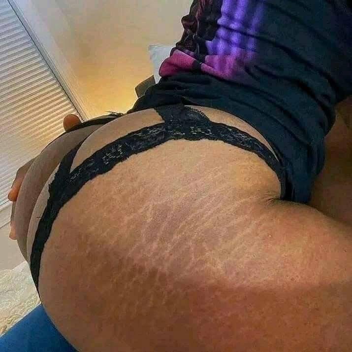 To girls with stretch marks.❤🔥