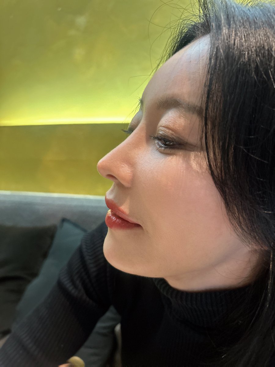 切らない透明人中が完成❕
加齢で間延びしていた人中と唇のエッジがパキッとキマった👄
私は筋肉処理ナシなので見た目の長さが変わったりはしてないけどそこはお好みで選択🉑
加齢により下がったCカールや古いヒアルでぼやけてしまった唇のエッジが糸で復活❗️
ナチュラル唇好きの人へ届け💌↓