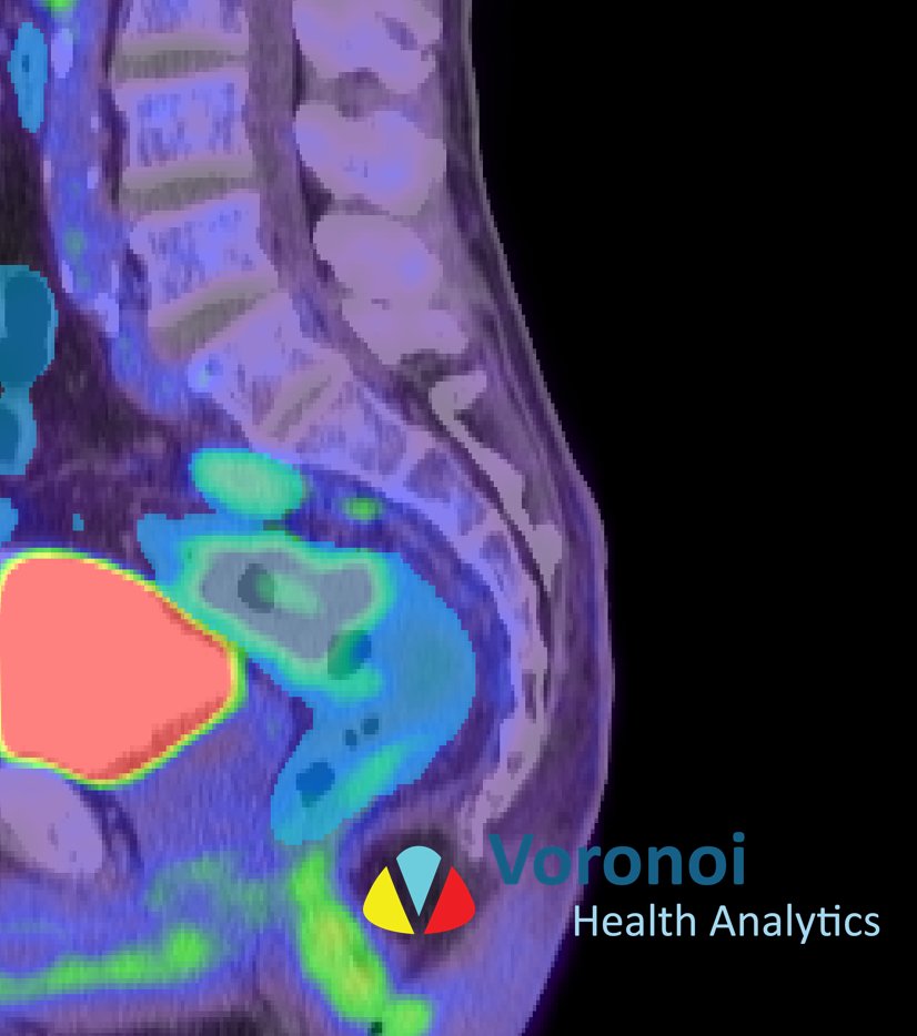 Our team <a href="/VoronoiHealth/">Voronoi Health Analytics Inc.</a> recognizes #ColorectalCancerAwareness month.  Our AI-driven imaging solutions help researchers uncover key biomarkers, driving innovation in prevention and treatment. Our software will inference the bowel in blue💙