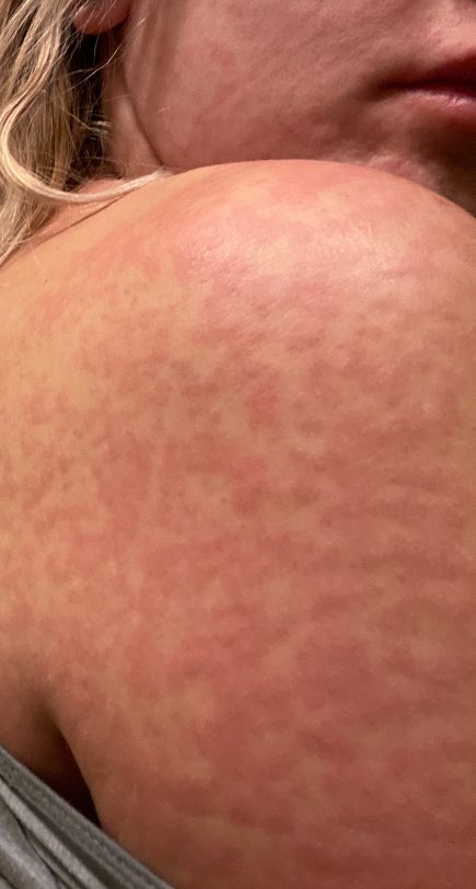 _bouboulina_'s tweet photo. In the meantime, I get hives from how hot it’s been and the immense stress I’ve been under. The host does not respond to my pleas to lower the temperature. @AirbnbHelp comes back and offers me partial refund that will take 5-15 days to only if I leave in a few hours https://t.co/1cfGmVbzYi