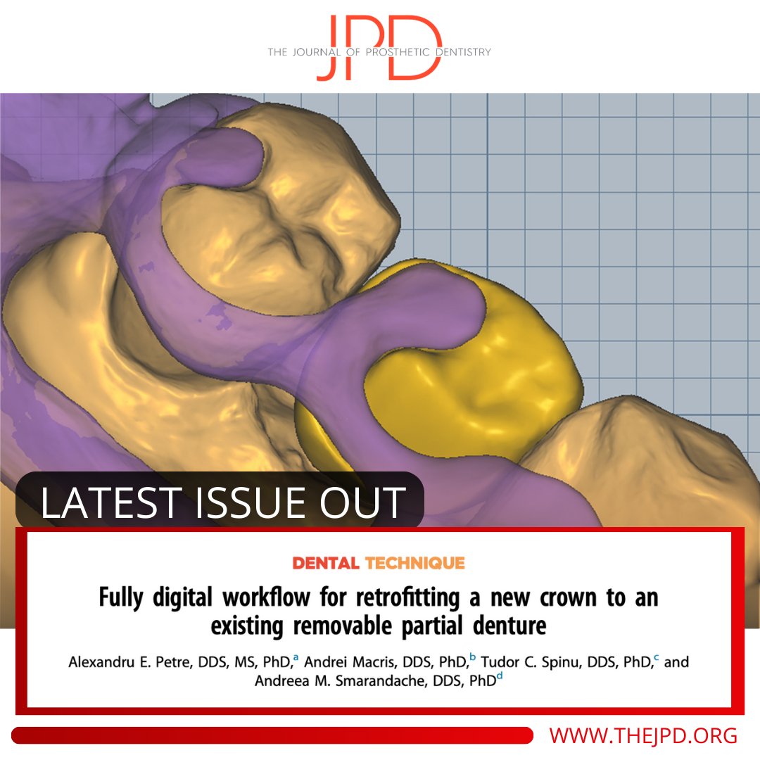 JPDentistry's tweet photo. The latest issue of #theJPD features this #dentaltechnique that describes the digital scans needed and #CAD process to design a survey #tooth crown that is retrofitted to an existing #removablepartialdenture in a fully digital workflow: https://t.co/435what2RM https://t.co/eTQRPR5MsY
