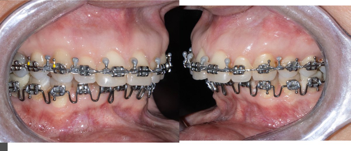 Victor_maxilof's tweet photo. ¿Te pueden romper los brackets en la cirugía? 😵 No, pero se deben reforzar antes para resistir la intervención. Se utilizan arcos más gruesos o brackets especiales para soportar la fijación intermaxilar. #Ortodoncia #Ortognática #Maxilofacial #Brackets #SaludDental https://t.co/NhwiqG0pTA