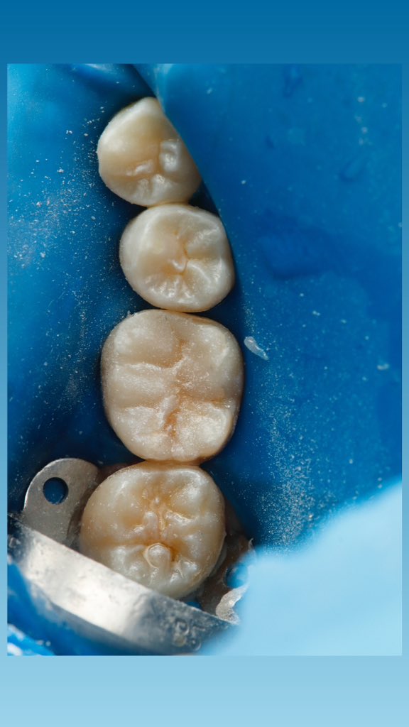 mh5ames's tweet photo. Case of old restoration with recurrent caries : https://t.co/j96Dtezknf