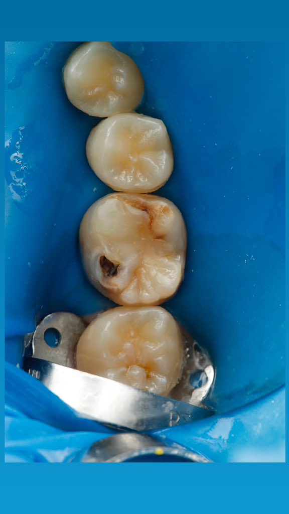 mh5ames's tweet photo. Case of old restoration with recurrent caries : https://t.co/j96Dtezknf