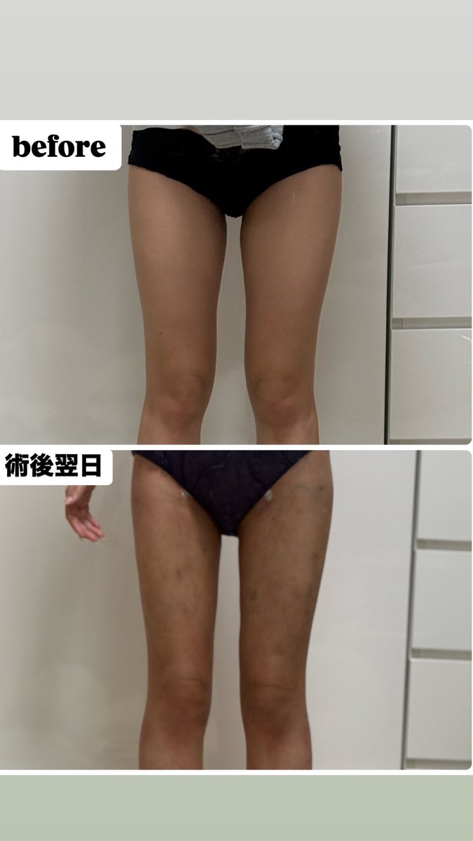 3月1日に太腿全周➕膝上の
脂肪吸引してきました🦵
とりあえずbefore→手術翌日の
変化載せます‼️内ももの肉感が
減って脚が真っ直ぐ見えるようになった😭❤️泣
ダウンタイムの様子はツリーに
残していきます😳‼️
 #脂肪吸引  #太腿脂肪吸引 https://t.co/oqOd581hzA