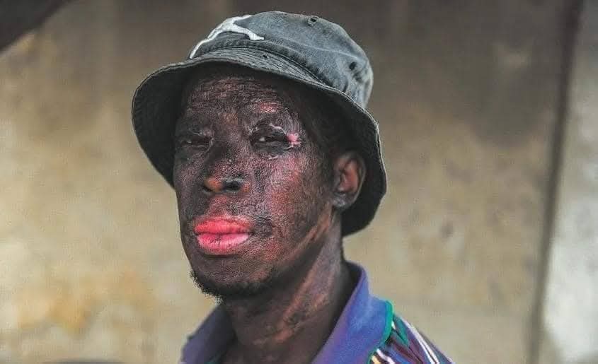 We we will never forget Zikhaya Sithole, a South African man who risked his life to save two kids that were trapped inside the burning shack. Unfortunately he managed to save only one and didn't have enough time to reach the other One-Year-Old baby whose life was claimed by the