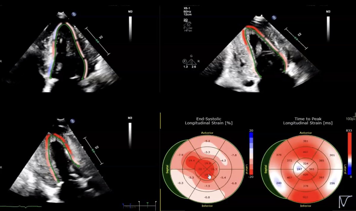 Yoshito Kadoya, MD PhD FACC FESC (@yoshito_kadoya) on Twitter photo 🔎 Key Echo Takeaways for #Amyloidosis:
• Thick walls (>12 mm) + large atria + pericardial effusion = not always specific
• “Starry sky” sign 🌌 isn’t specific—use GLS to quantify
• Apical sparing with normal LVEF can be a major clue 🏆
#CVNuc <a href="/MyASNC/">ASNC Society</a> 🔎 Key Echo Takeaways for #Amyloidosis:
• Thick walls (>12 mm) + large atria + pericardial effusion = not always specific
• “Starry sky” sign 🌌 isn’t specific—use GLS to quantify
• Apical sparing with normal LVEF can be a major clue 🏆
#CVNuc <a href="/MyASNC/">ASNC Society</a>
