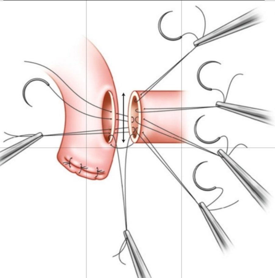 Syed A. Ahmad (@syedaahmad5) on Twitter photo Modified Blumgart Kelly technique for hepaticojejunotomy.
<a href="/TomVargheseJr/">Tom Varghese Jr. MD, MS, MBA, FACS, MAMSE ๐บ๐ธ</a> <a href="/juliomayol/">Julio Mayol</a> <a href="/SSATNews/">SSAT</a> <a href="/SocSurgOnc/">Society of Surgical Oncology</a> Modified Blumgart Kelly technique for hepaticojejunotomy.
<a href="/TomVargheseJr/">Tom Varghese Jr. MD, MS, MBA, FACS, MAMSE ๐บ๐ธ</a> <a href="/juliomayol/">Julio Mayol</a> <a href="/SSATNews/">SSAT</a> <a href="/SocSurgOnc/">Society of Surgical Oncology</a>